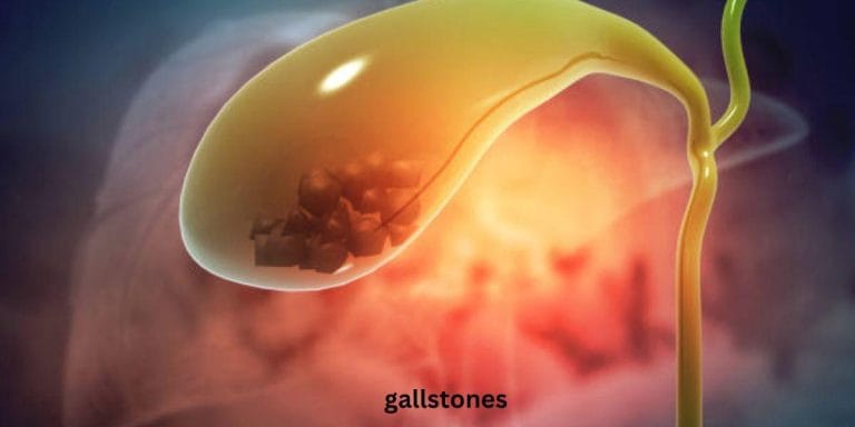পিত্তথলির পাথর গলানোর হোমিওপ্যাথিক ঔষধ