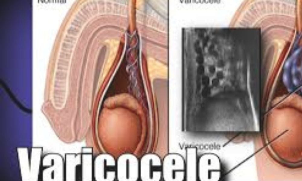 ভেরিকোসিল এর হোমিও চিকিৎসা