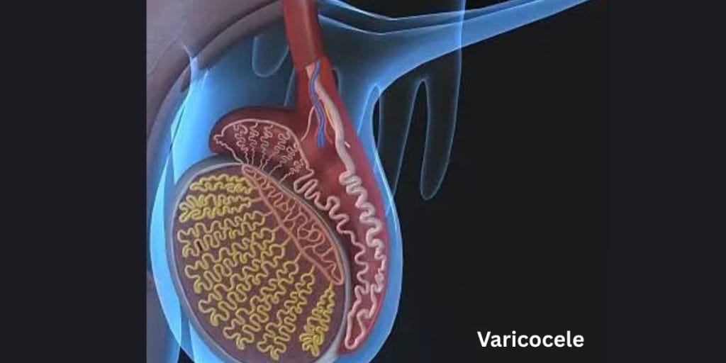 Varicocele treatment without surgery
