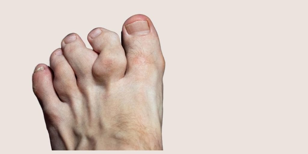 Uric Acid Treatment ও কমানোর উপায়: Best Medicine, Diet Plan & Cost Guide (2026)