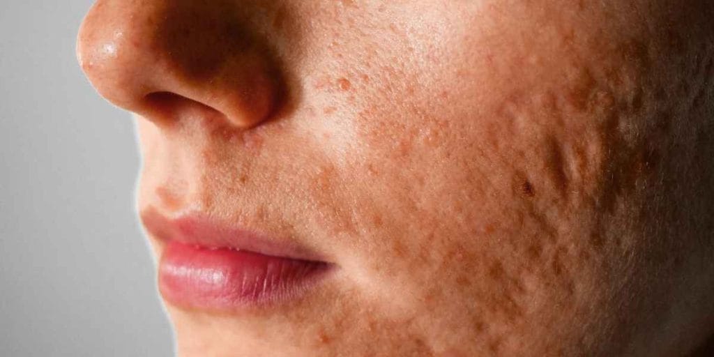 ত্বকের দাগ দূর করতে এই ৪টি হোমিও ওষুধ কাজে দেবে 