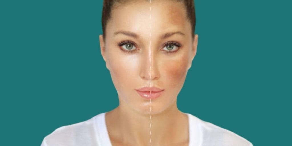 ত্বকের দাগ দূর করতে এই ৪টি হোমিও ওষুধ কাজে দেবে