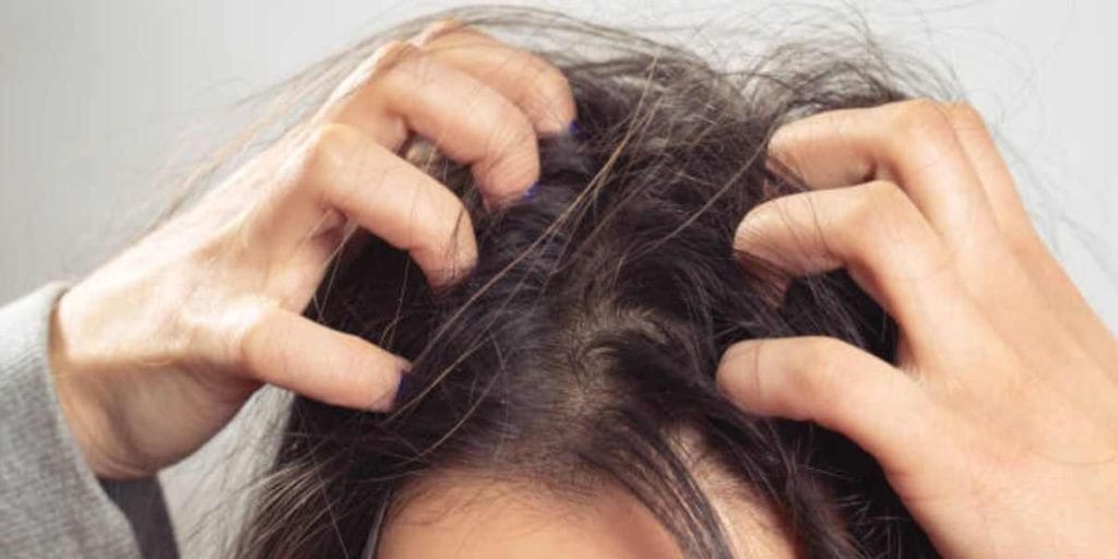 খুশকি-dandruff হোমিওপ্যাথি চিকিৎসা