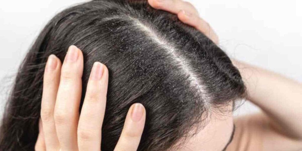 খুশকি ও চুলকানির যন্ত্রণা থেকে মুক্তি: হোমিওপ্যাথি চিকিৎসা দেবে স্থায়ী সমাধান