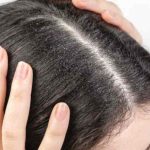 খুশকি ও চুলকানির যন্ত্রণা থেকে মুক্তি: হোমিওপ্যাথি চিকিৎসা দেবে স্থায়ী সমাধান খুশকি ও চুলকানির যন্ত্রণা থেকে মুক্তি: হোমিওপ্যাথি চিকিৎসা দেবে স্থায়ী সমাধান