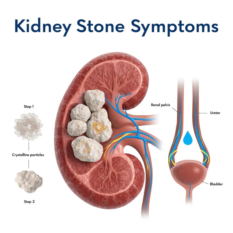 Kidney Stone Treatment in Homeopathy