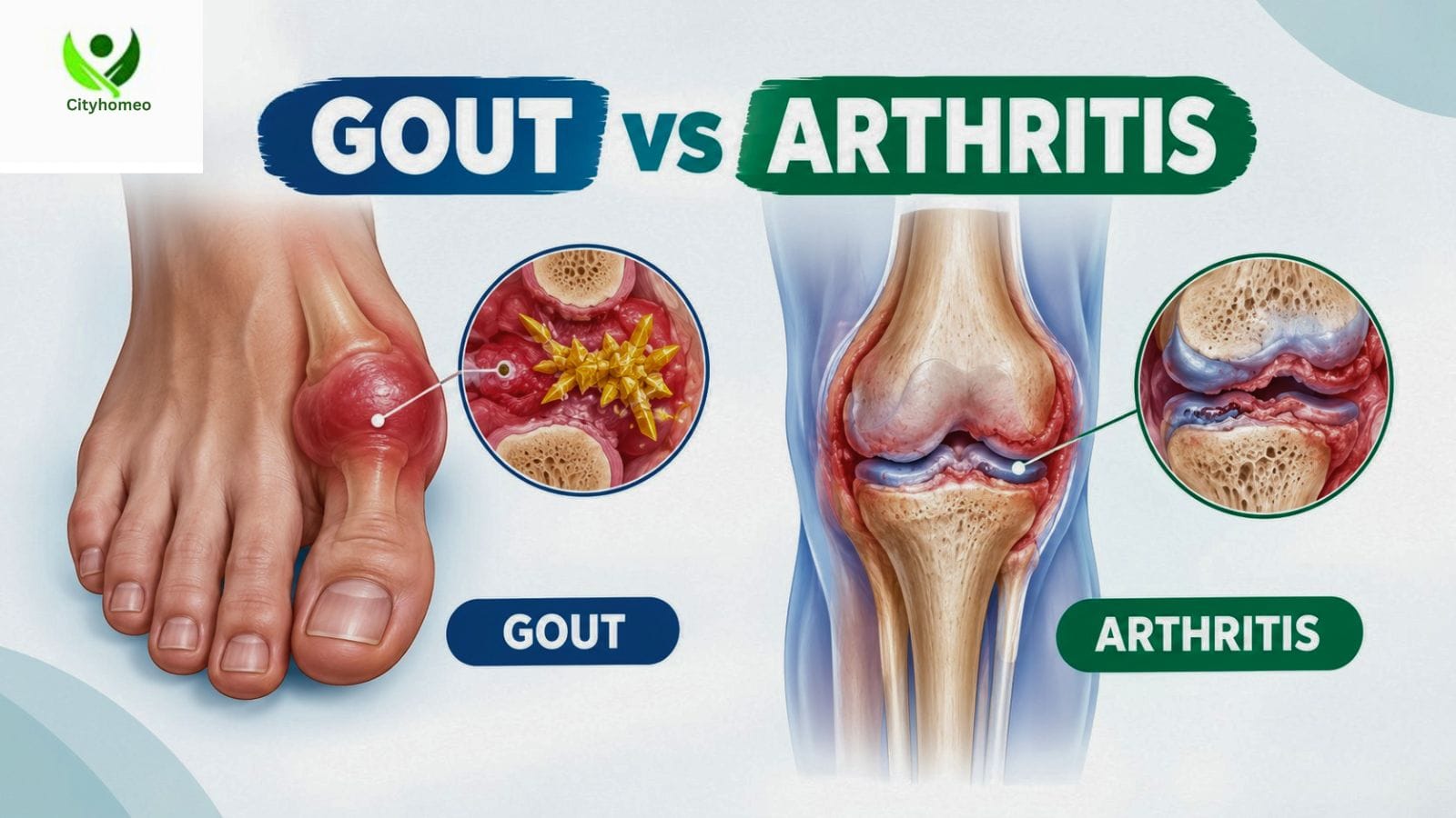 Gout vs arthritis differenc