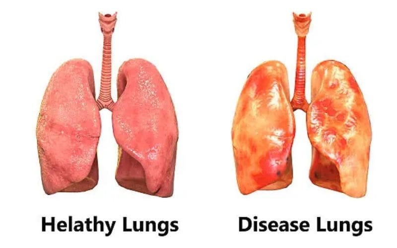 Comparison of healthy lungs and lungs affected by cancer