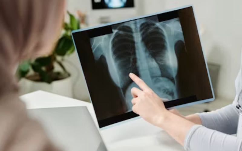 Low-dose CT scan used for lung cancer screening