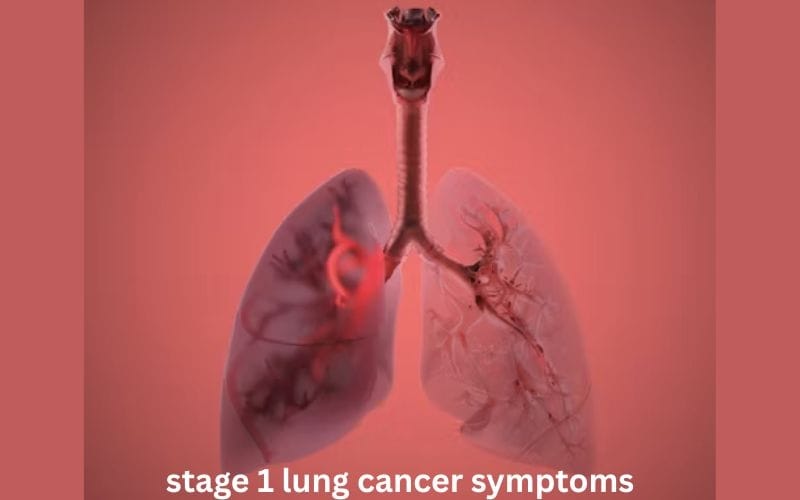 Illustration explaining Stage 1 lung cancer symptoms